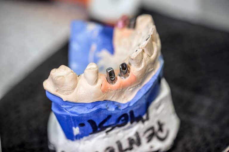 dental implants 2021 08 26 17 52 15 utc 1