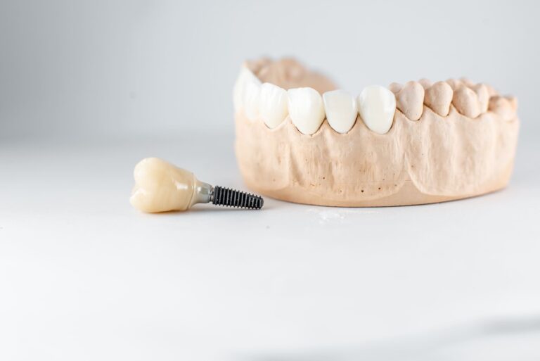model of artificial jaw and dental implant 2021 09 01 14 46 55 utc 1